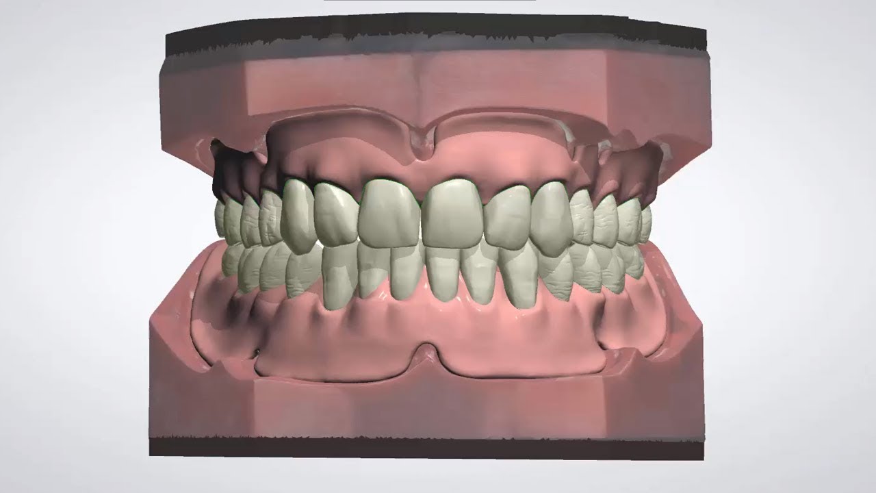 Digital Denture Design Service – Digital Dental Prosthetics