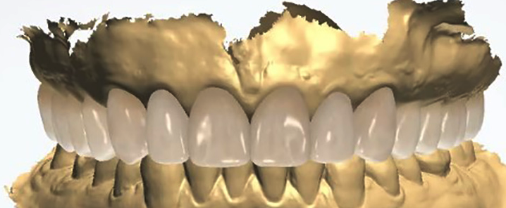 Digital Smile Design | Diagnostic Wax-Up