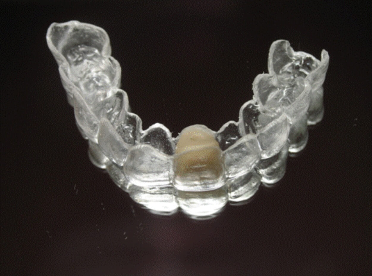 Clear Essix Pontic Retainer – Digital Dental Prosthetics