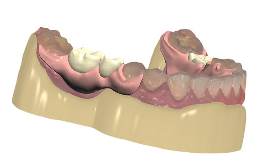 Removable Partial Denture Design